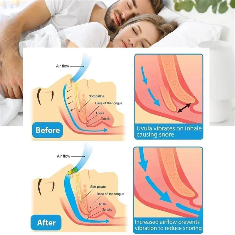 Silicone Magnético Anti-Ronco - Zero Ronco (Compre 2 Leve 4)